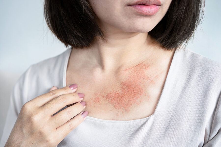 Rashes | Dermatology Associates Skin & Cancer