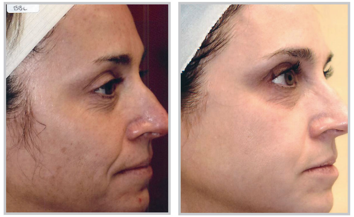 forever-young-bbl-03