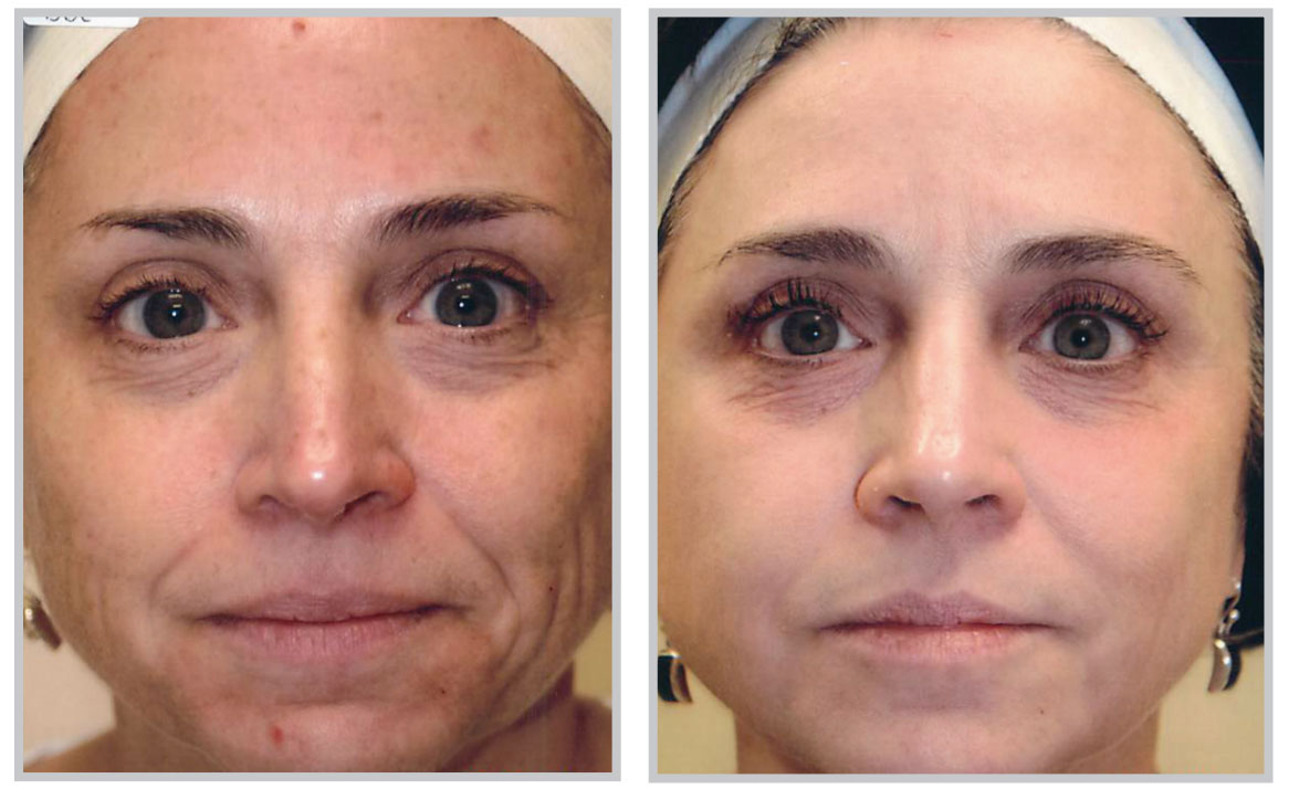 forever-young-bbl-07